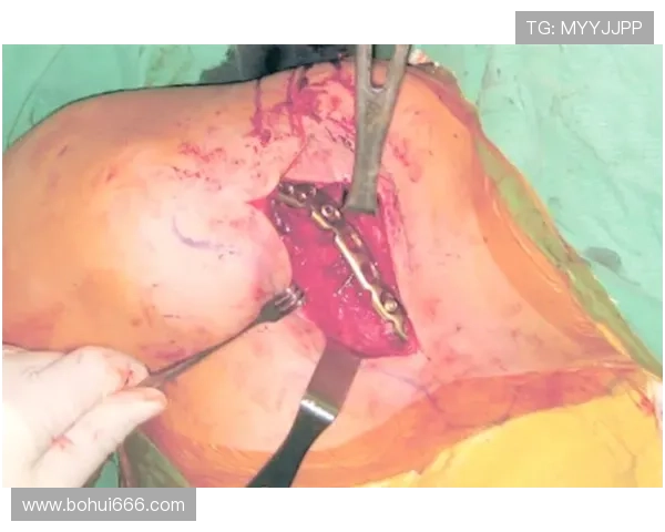 西汉姆官方宣布19岁小将斯卡尔斯成功完成锁骨骨折修复手术